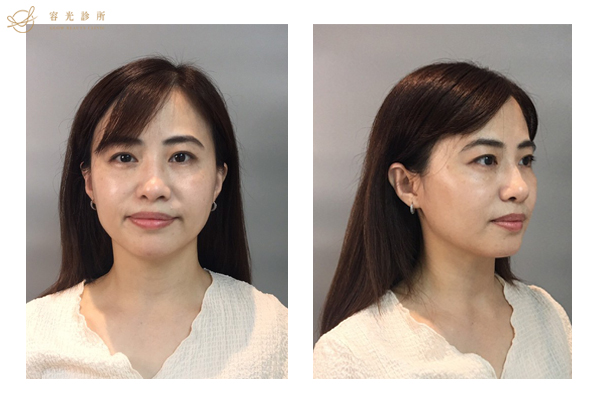 存奕美學.肉毒小臉.周建存醫師