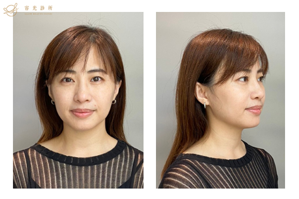 肉毒小臉術後.存奕美學診所