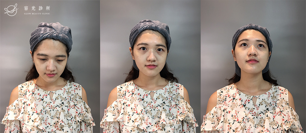 玻尿酸淚溝.眼袋.