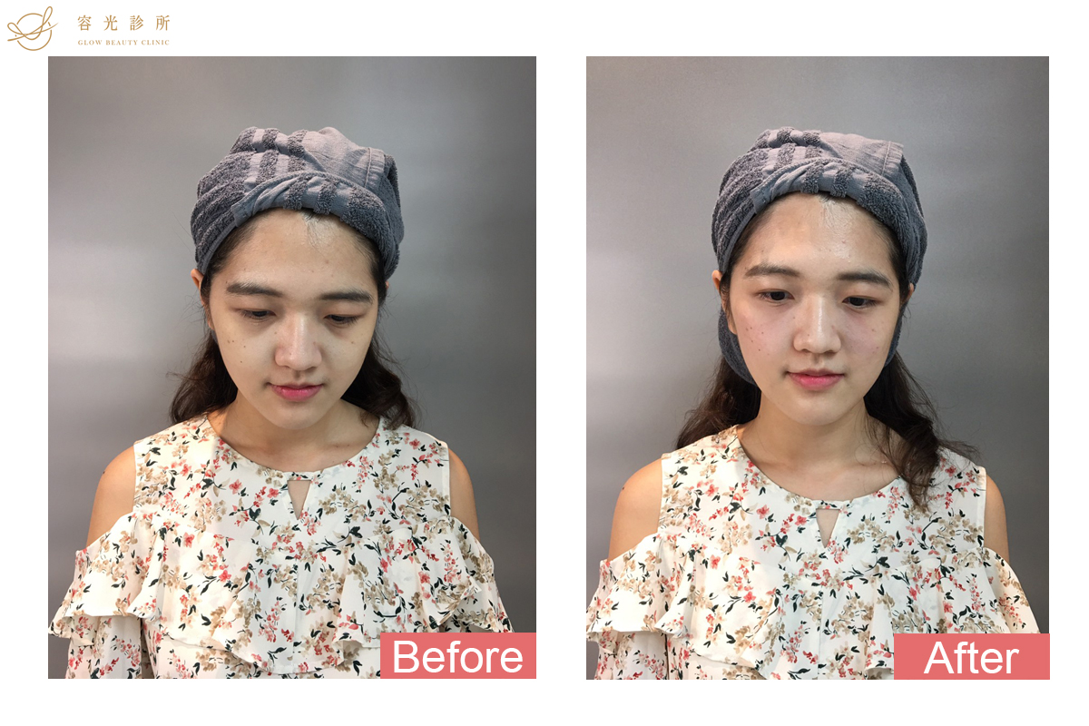 玻尿酸淚溝.術前術後比較.周建存醫師