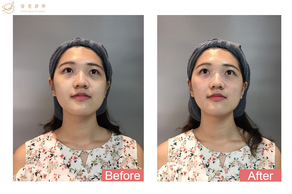 玻尿酸淚溝.術前術後比較.存奕美學診所