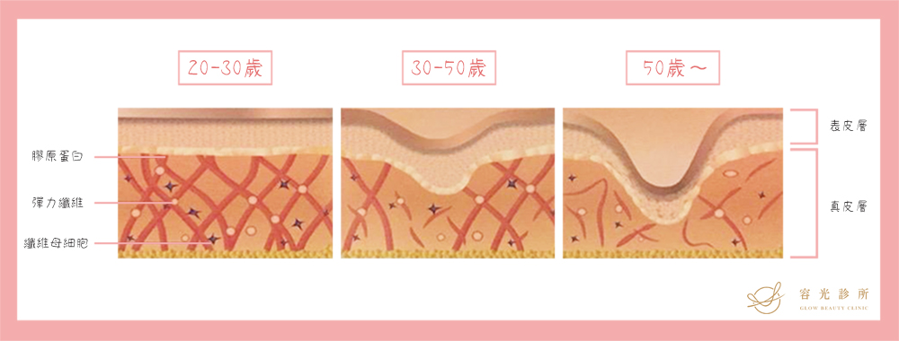 AestheFill&reg;艾麗斯(俗稱精靈針)