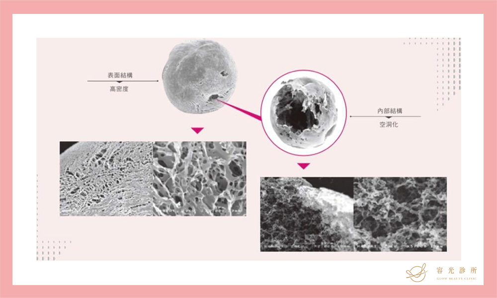 AestheFill&reg;艾麗斯(俗稱精靈針)