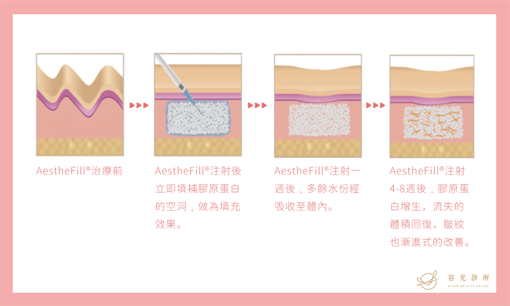 AestheFill&reg;艾麗斯(俗稱精靈針)