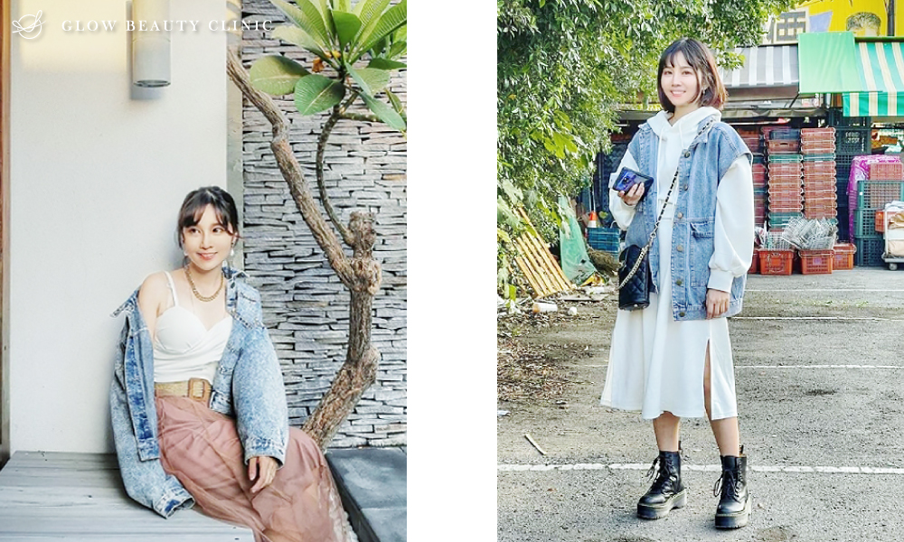 埋線隆鼻.周建存院長.存奕美學.6D鼻雕.埋線隆鼻案例.埋線隆鼻效果.埋線隆鼻術後