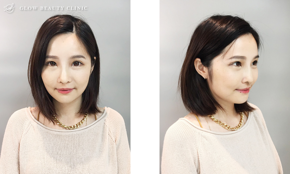 埋線隆鼻.周建存院長.存奕美學.6D鼻雕.埋線隆鼻案例.埋線隆鼻效果.埋線隆鼻術後