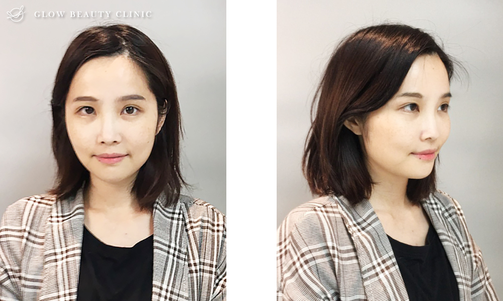 埋線隆鼻.周建存院長.存奕美學.6D鼻雕.埋線隆鼻案例.埋線隆鼻效果