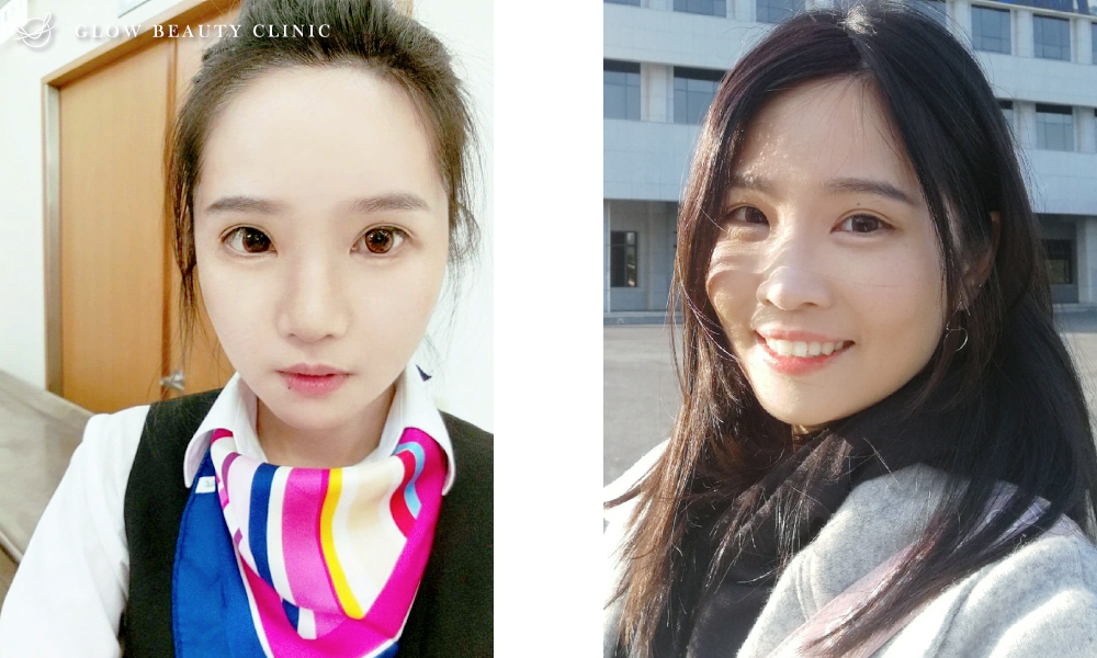 埋線隆鼻.周建存院長.存奕美學.6D鼻雕